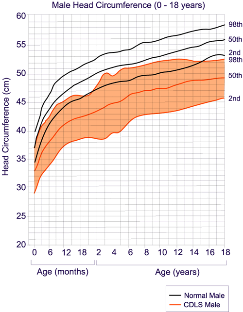 Cornelia De Lange Syndrome Growth Chart